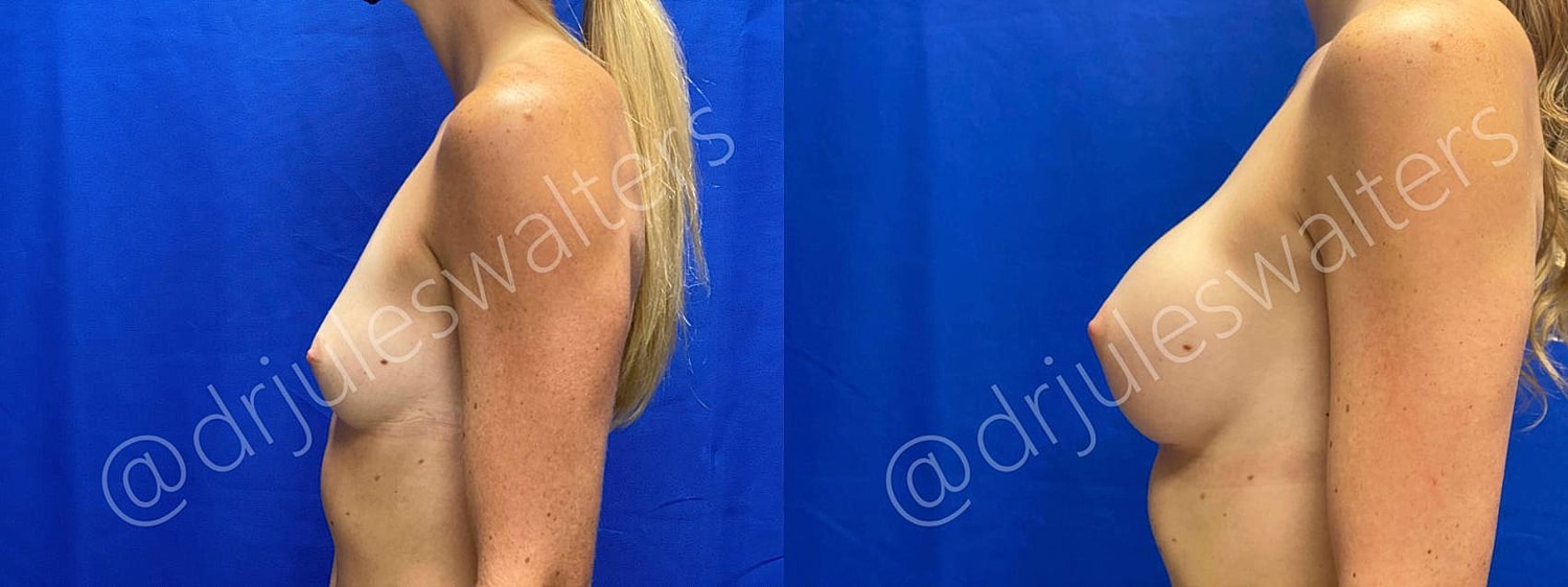Breast Augmentation Before & After