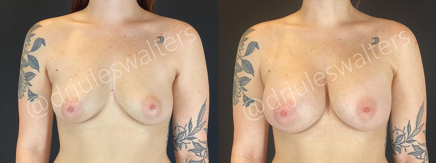 Breast Augmentation Before & After