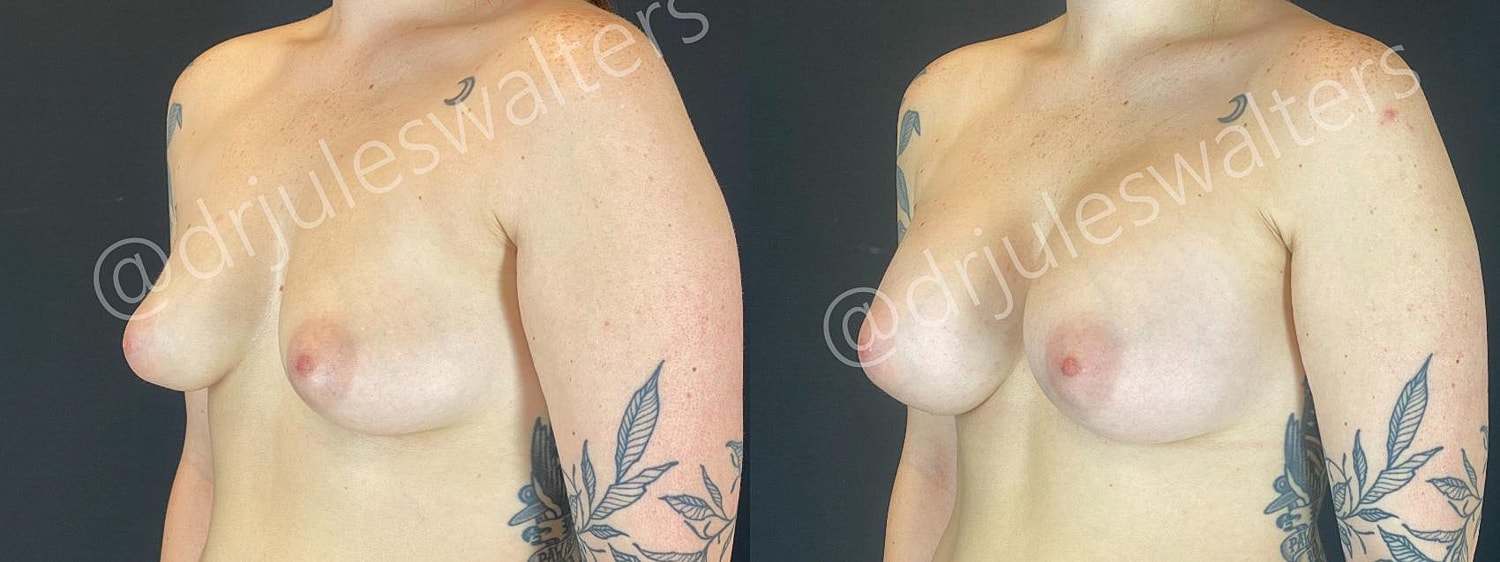 Breast Augmentation Before & After