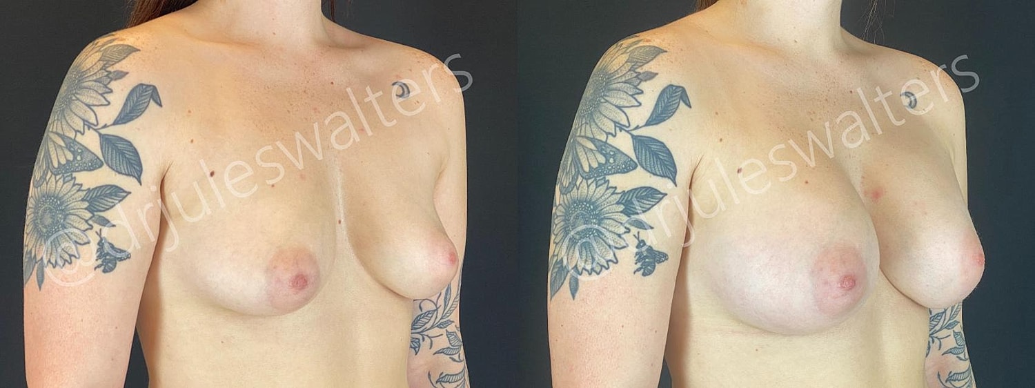 Breast Augmentation Before & After