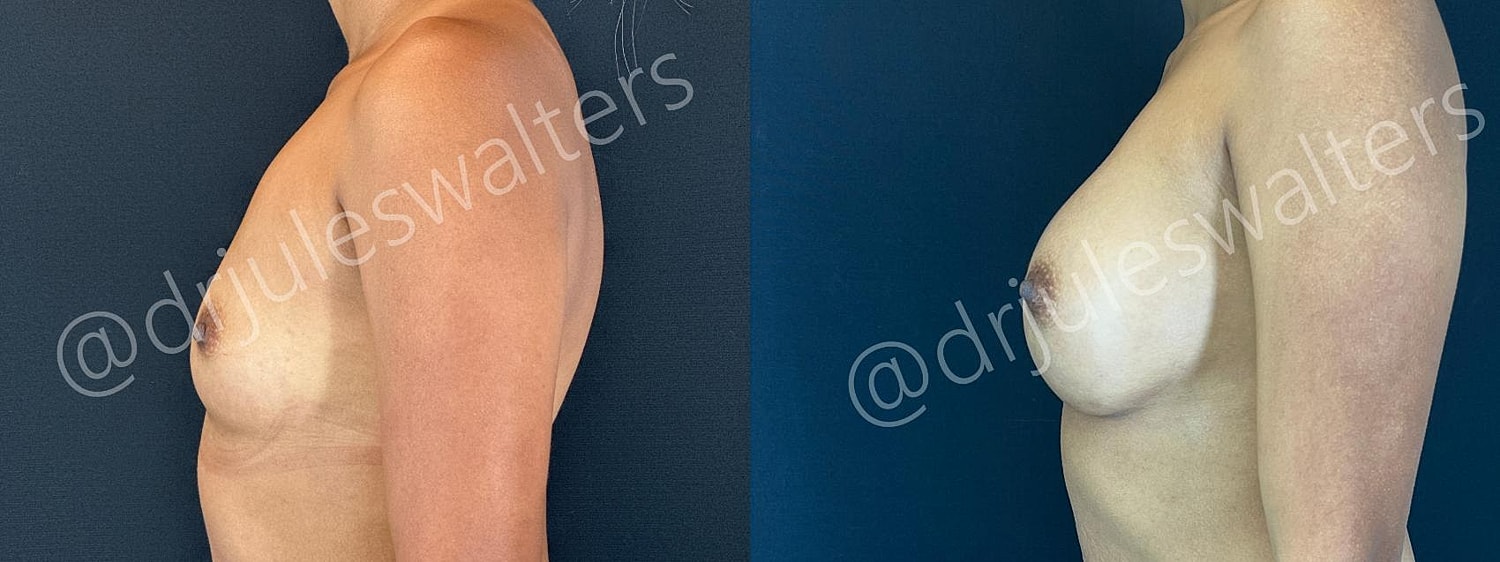 Breast Augmentation Before & After