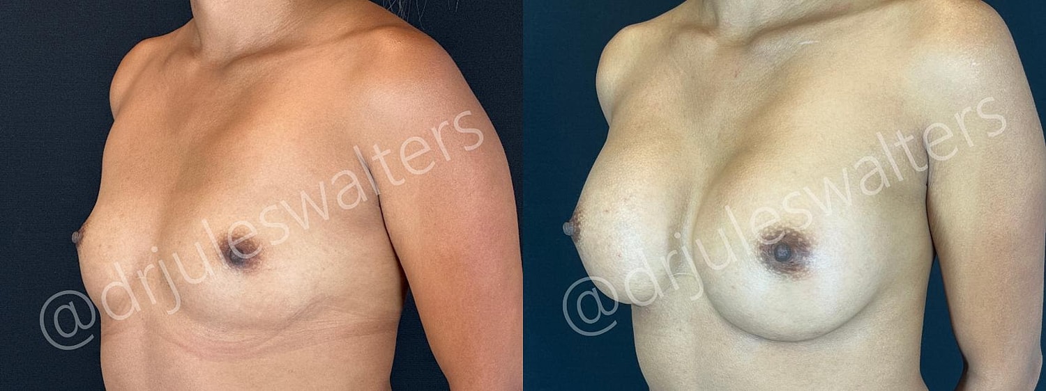 Breast Augmentation Before & After