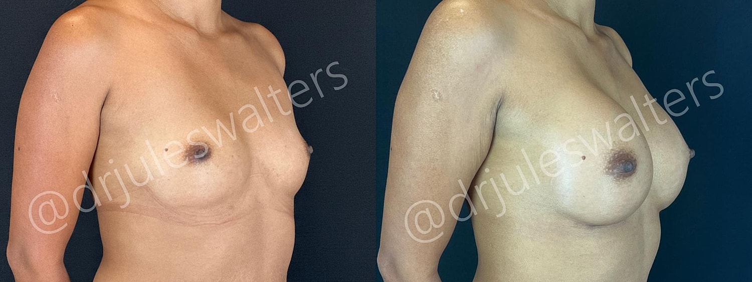 Breast Augmentation Before & After