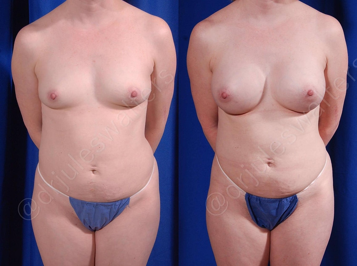 Breast Augmentation Before & After