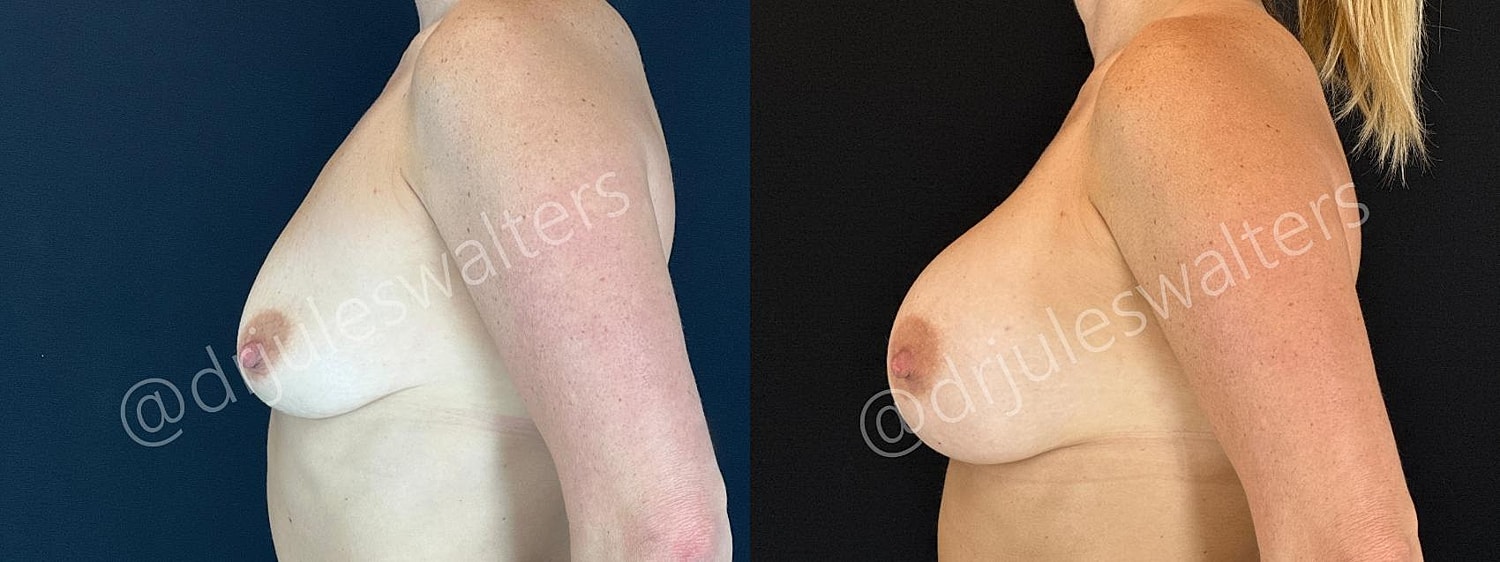Breast Augmentation Before & After