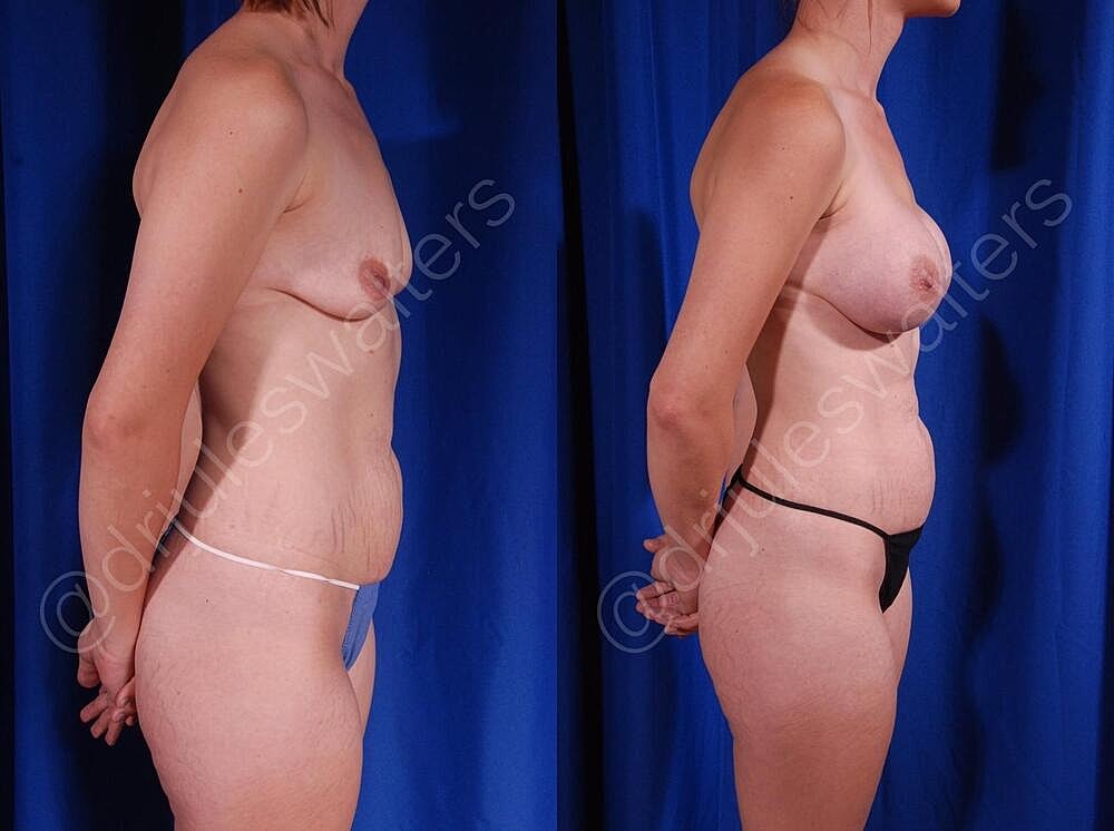 Breast Augmentation Before & After