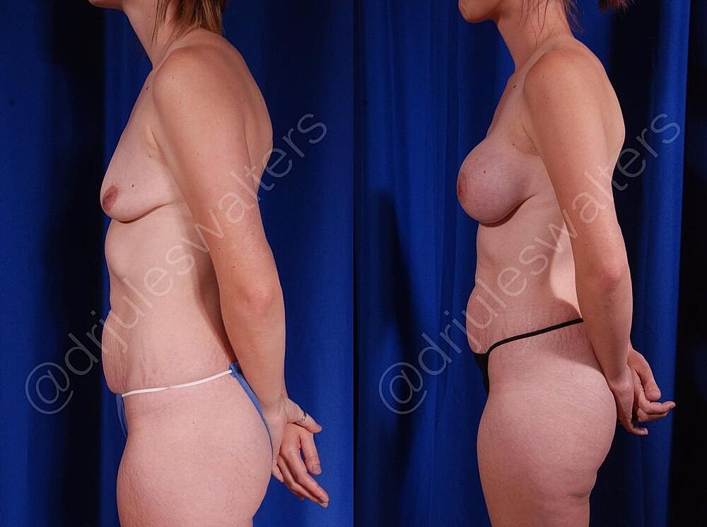 Breast Augmentation Before & After