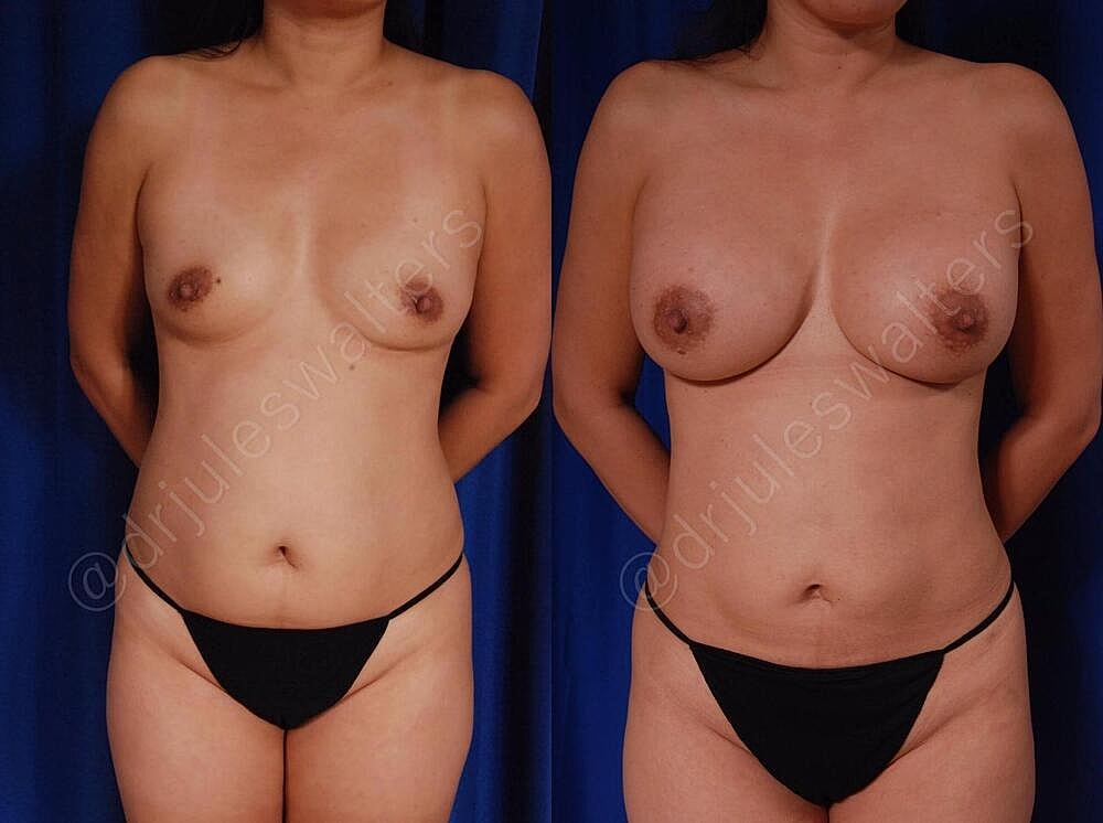 Breast Augmentation Before & After