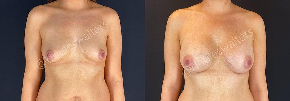Breast Augmentation Before & After