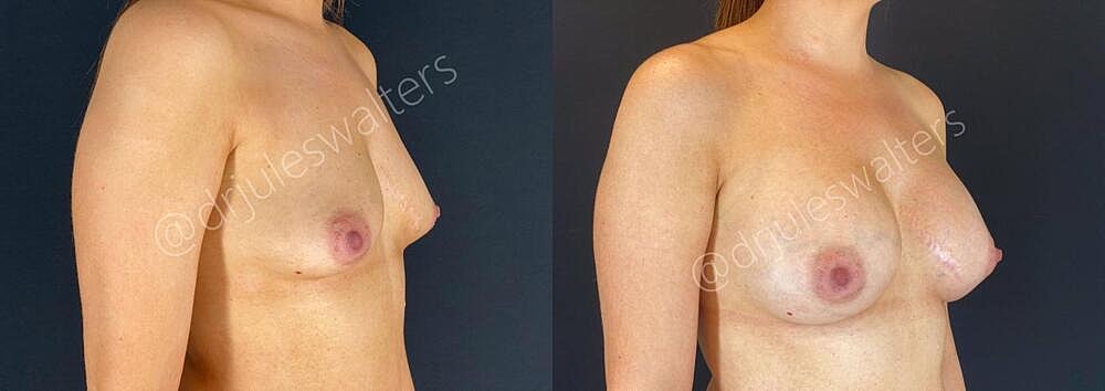 Breast Augmentation Before & After