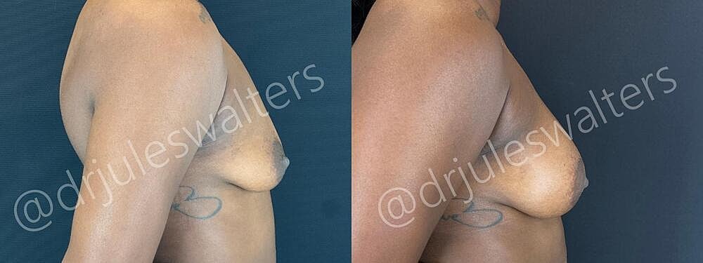 Breast Augmentation Before & After