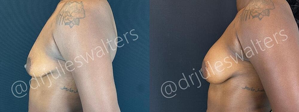 Breast Augmentation Before & After