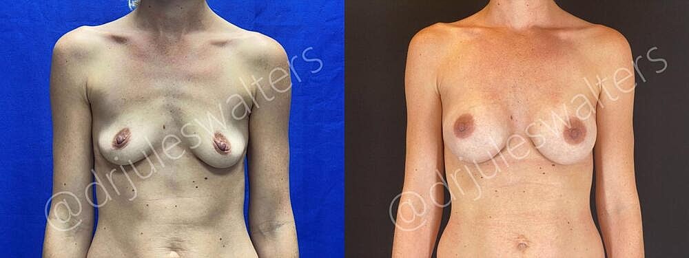 Breast Augmentation Before & After