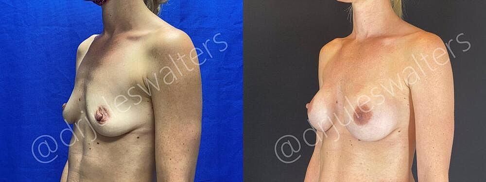 Breast Augmentation Before & After