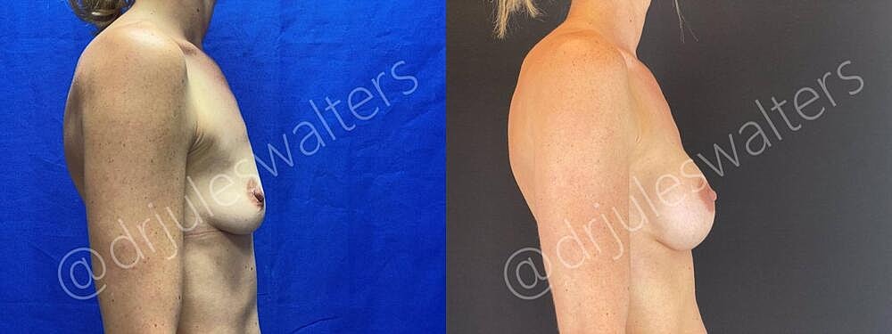 Breast Augmentation Before & After