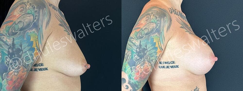 Breast Augmentation Before & After