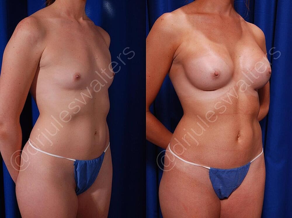 Breast Augmentation Before & After