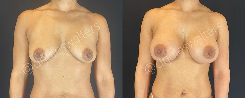Breast Augmentation Before & After