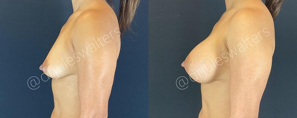 Breast Augmentation Before & After