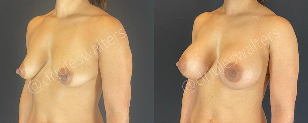 Breast Augmentation Before & After