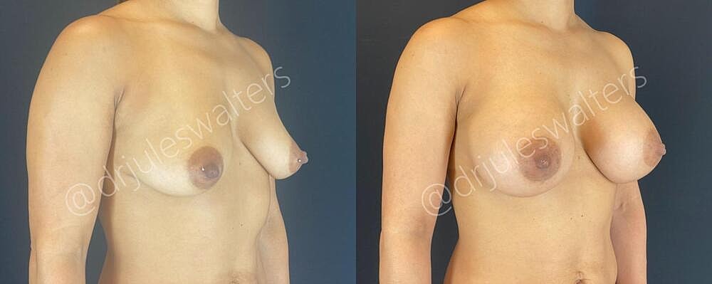 Breast Augmentation Before & After