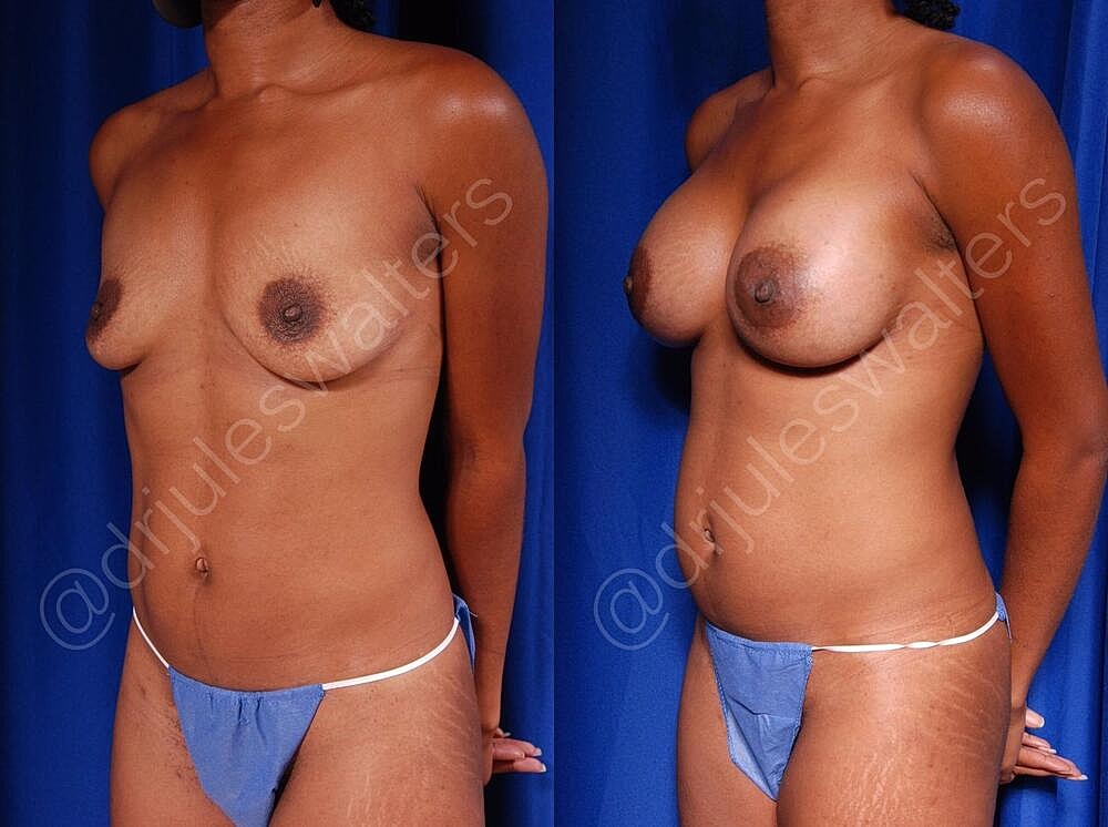 Breast Augmentation Before & After