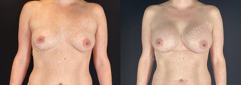 Breast Augmentation Before & After