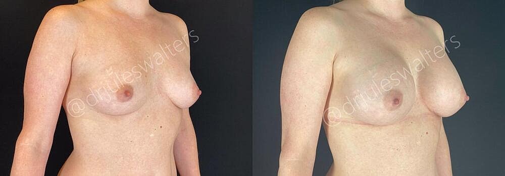 Breast Augmentation Before & After