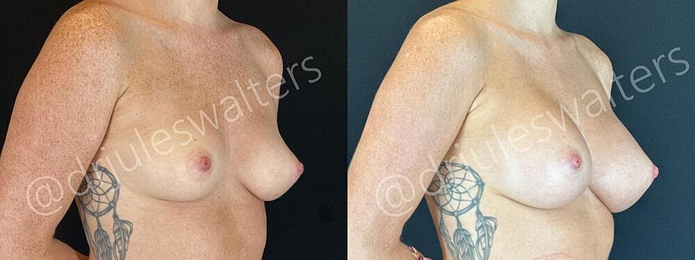 Breast Augmentation Before & After