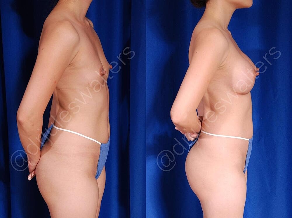Breast Augmentation Before & After