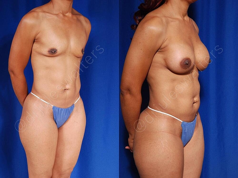 Breast Augmentation Before & After