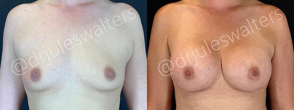 Breast Augmentation Before & After