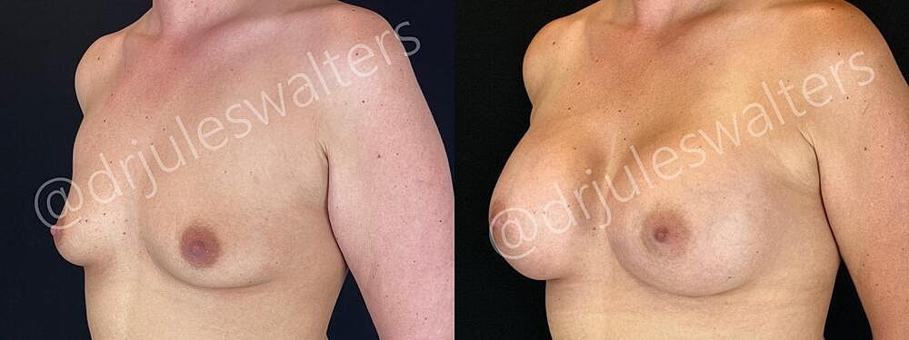 Breast Augmentation Before & After