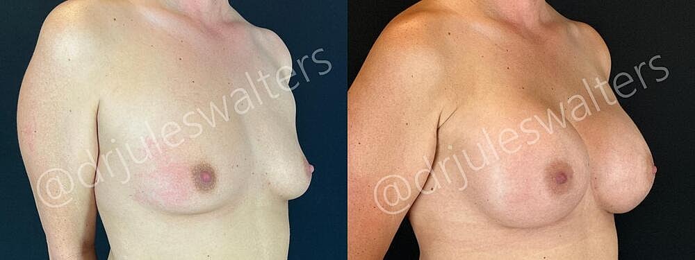 Breast Augmentation Before & After