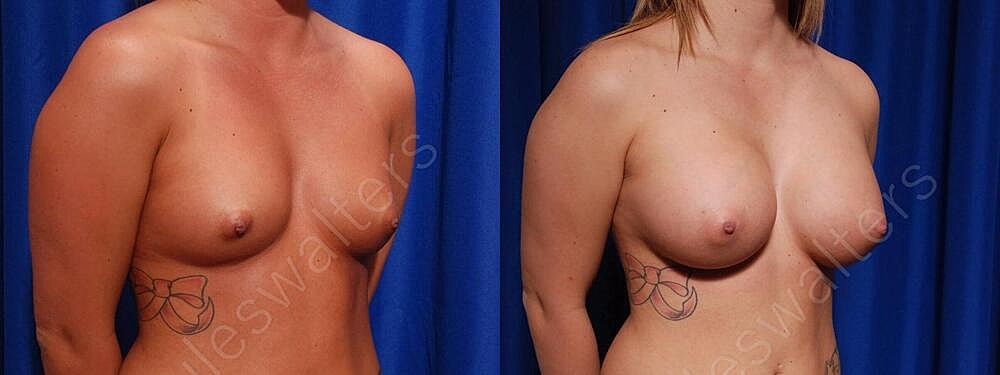 Breast Augmentation Before & After