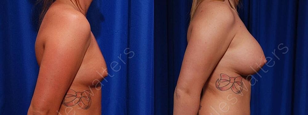 Breast Augmentation Before & After