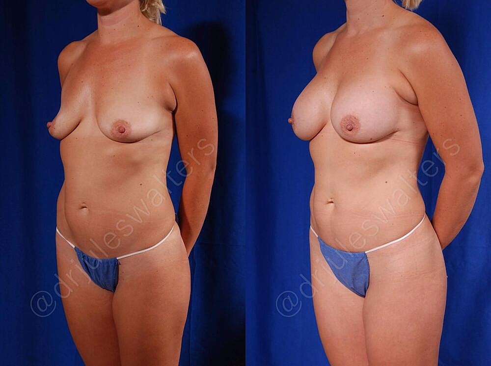 Breast Augmentation Before & After