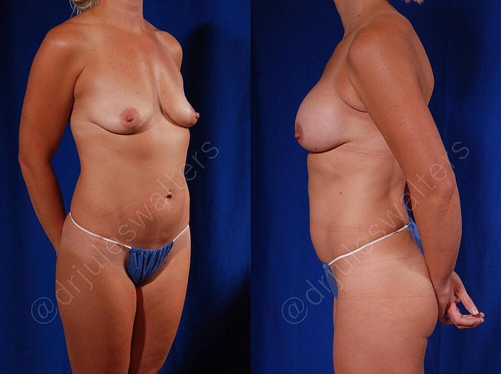 Breast Augmentation Before & After