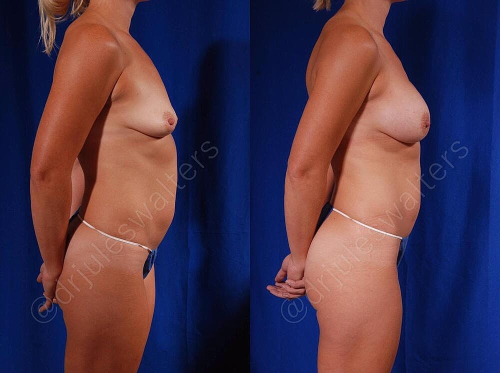 Breast Augmentation Before & After