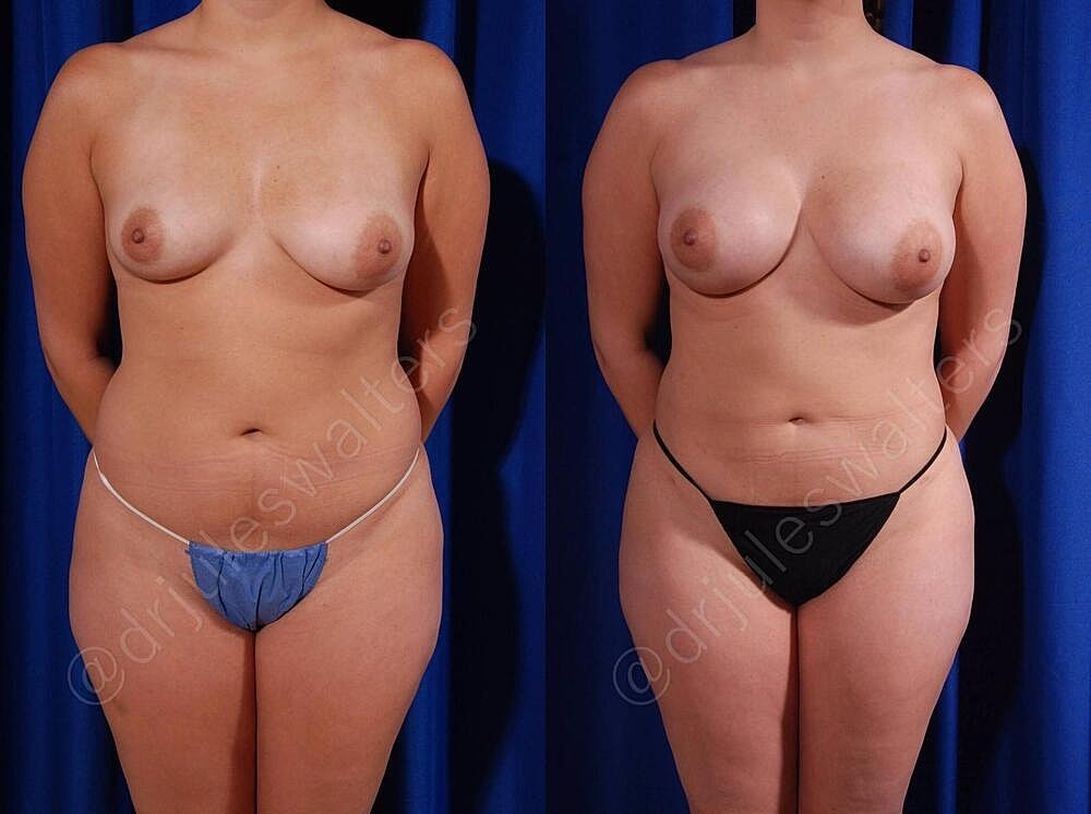 Breast Augmentation Before & After