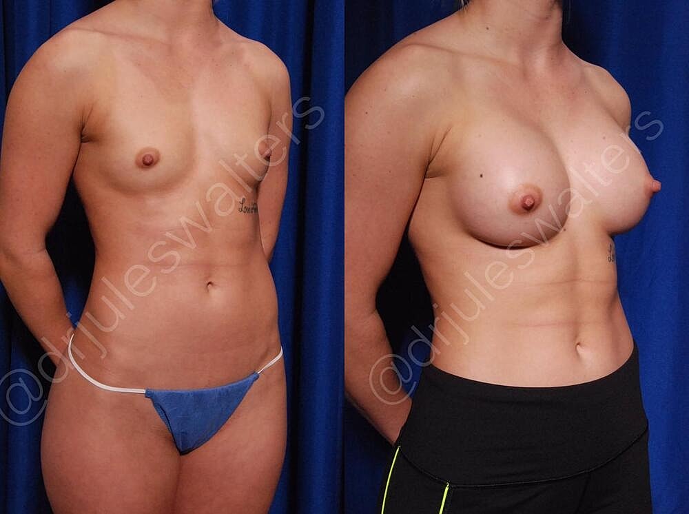 Breast Augmentation Before & After