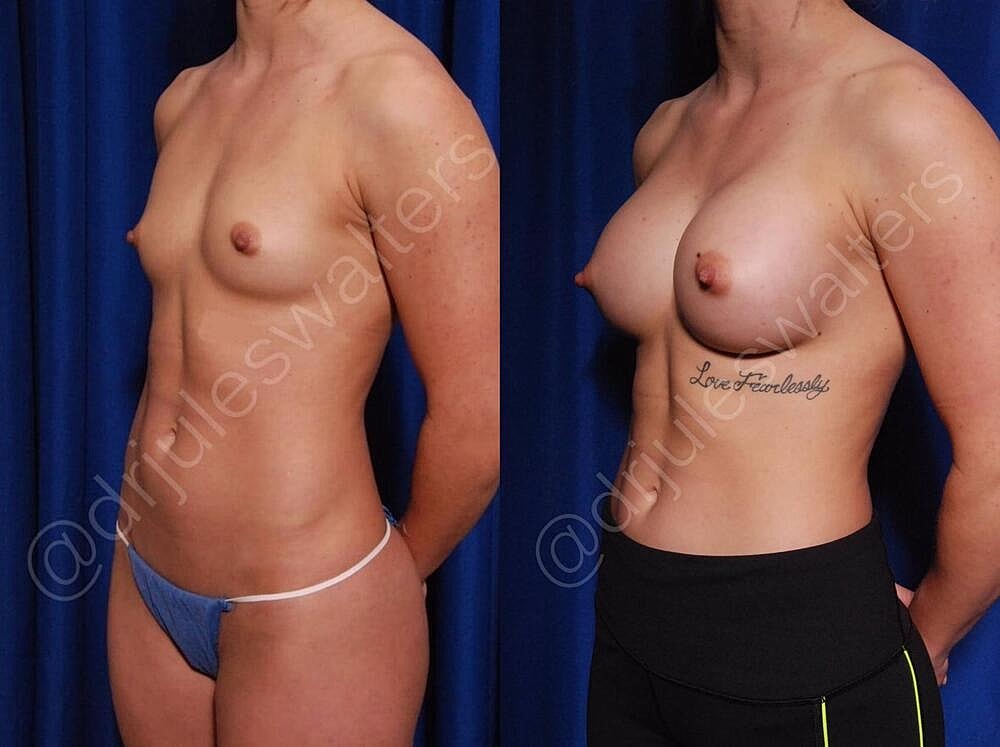 Breast Augmentation Before & After