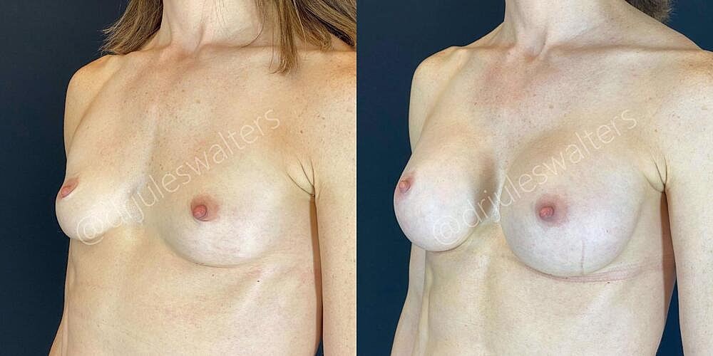 Breast Augmentation Before & After
