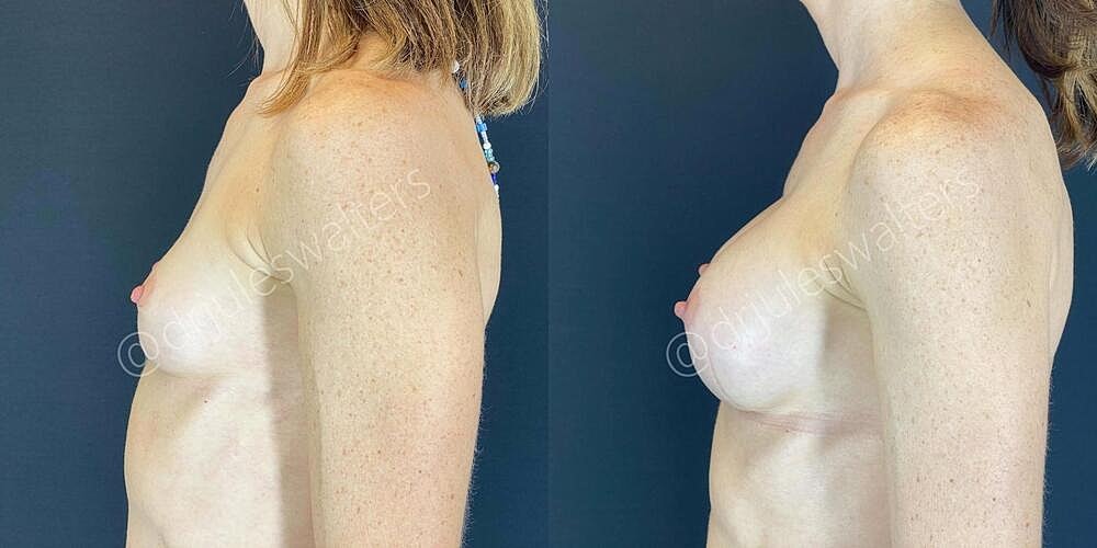 Breast Augmentation Before & After