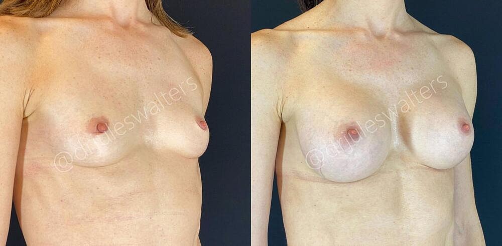 Breast Augmentation Before & After
