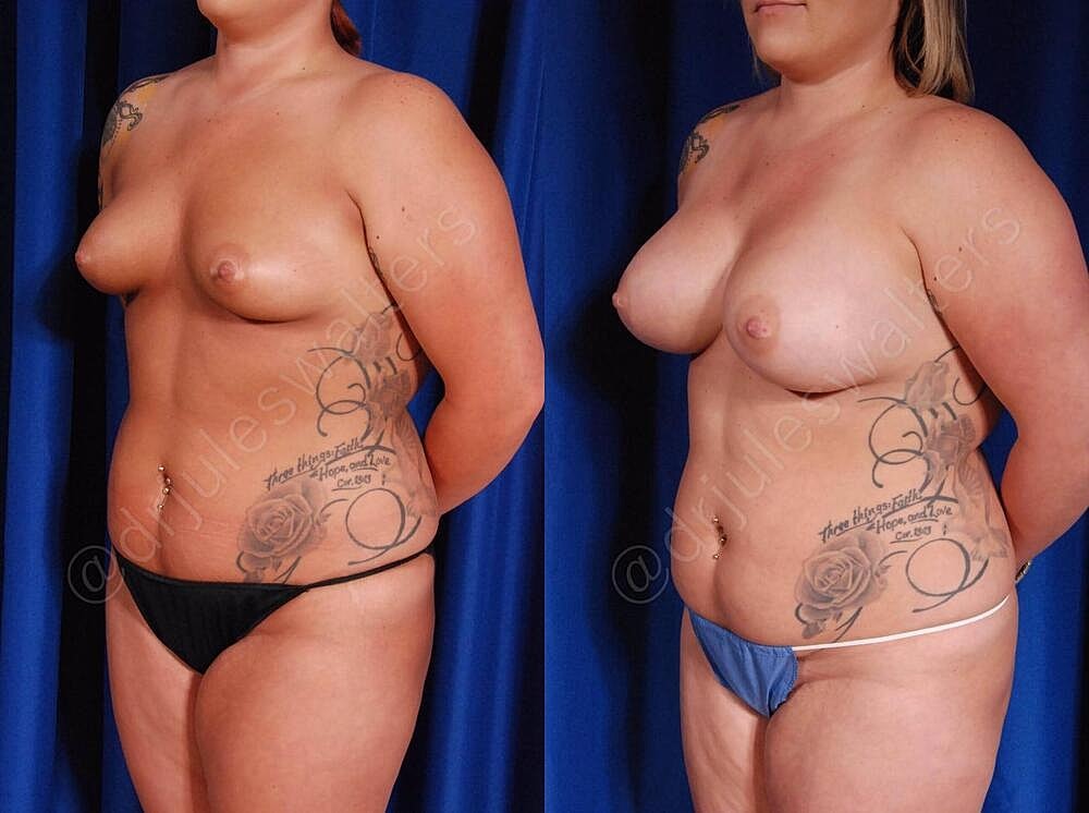 Breast Augmentation Before & After