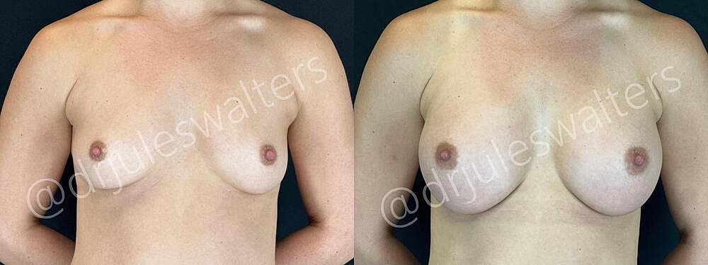 Breast Augmentation Before & After