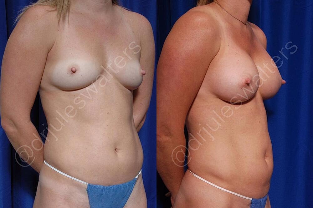 Breast Augmentation Before & After