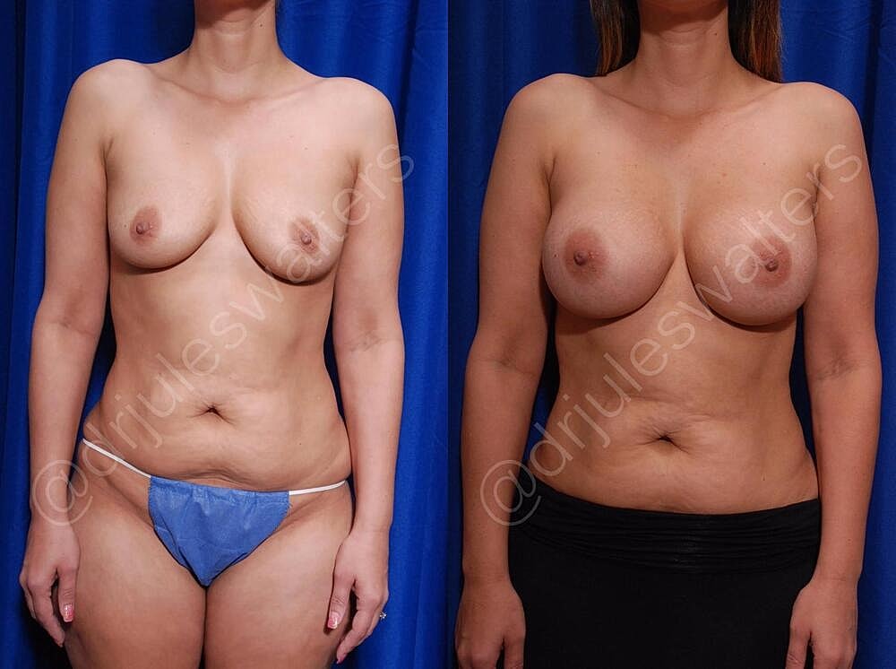 Breast Augmentation Before & After