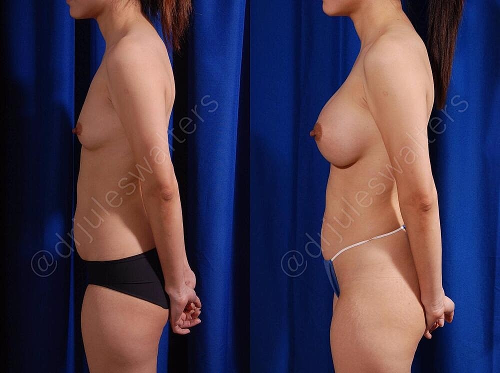 Breast Augmentation Before & After